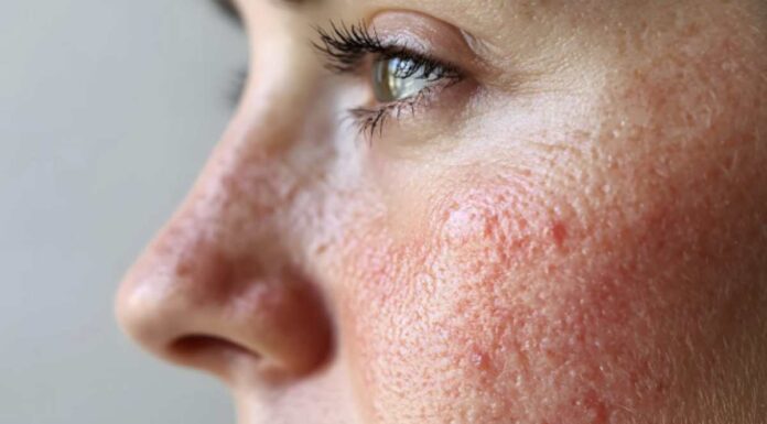 Couperose sul viso, l’errore che peggiora il rossore (e lo fanno tutti senza saperlo) Un errore comune, spesso inconsapevole, può peggiorare questo rossore, aggravando la condizione cutanea