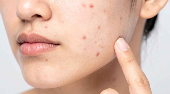 La mia pelle era piena di imperfezioni, poi ho scoperto questo trattamento allo zolfo a pochi euro pelle con imperfezioni: prova il trattamento allo zolfo