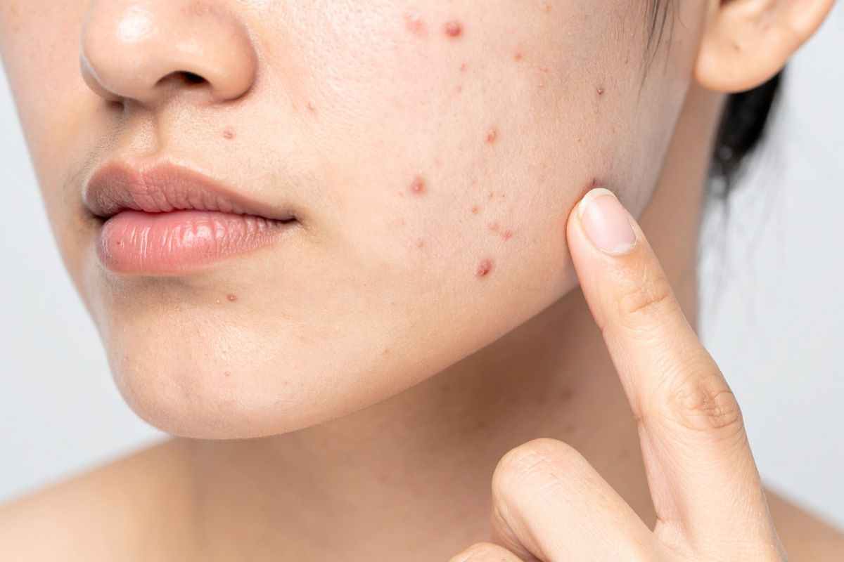 pelle con imperfezioni: prova il trattamento allo zolfo