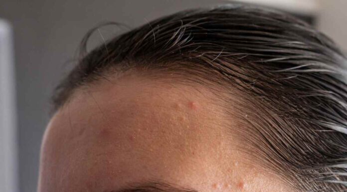 Dove spuntano i brufoli dice molto sulla tua salute: se compaiono qui dovresti preoccuparti Dove spuntano i brufoli dice molto sulla tua salute