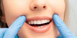 denti bianchi come fare