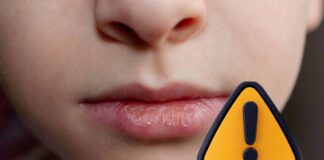 labbra screpolate la skincare