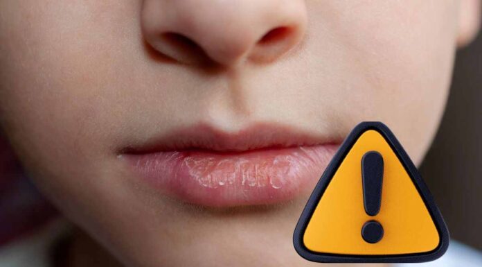 SOS inverno: il trucco definitivo per proteggere le labbra dal gelo imminente labbra screpolate la skincare