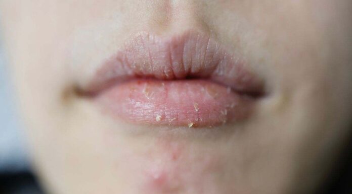 Stop alle labbra secche in inverno: Il balsamo labbra “miracoloso” a 6 euro che batte tutta la concorrenza balsamo labbra a 6 euro contro le labbra secche