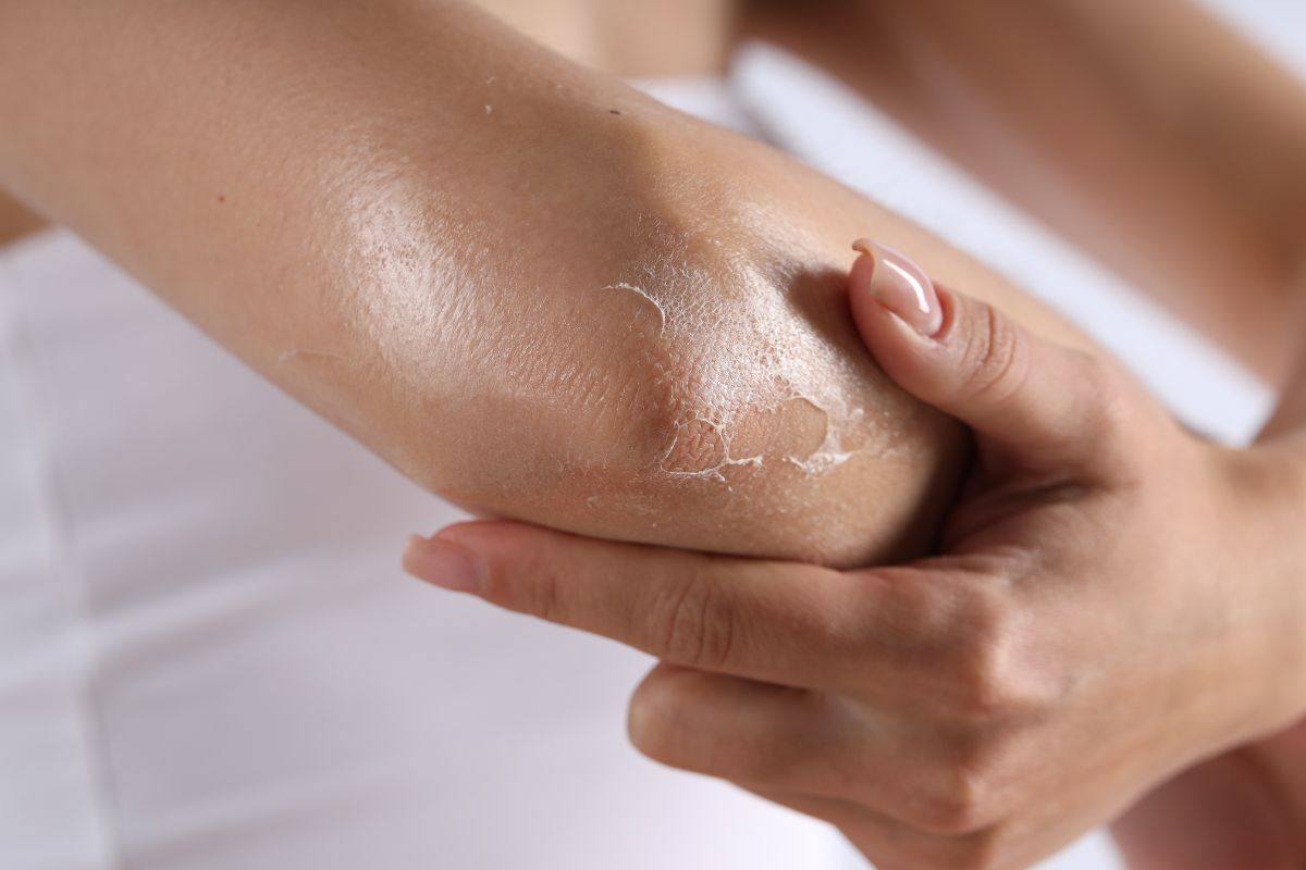 pelle secca rimedi naturali e non