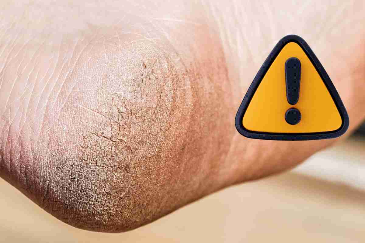 piedi screpolati rimedio