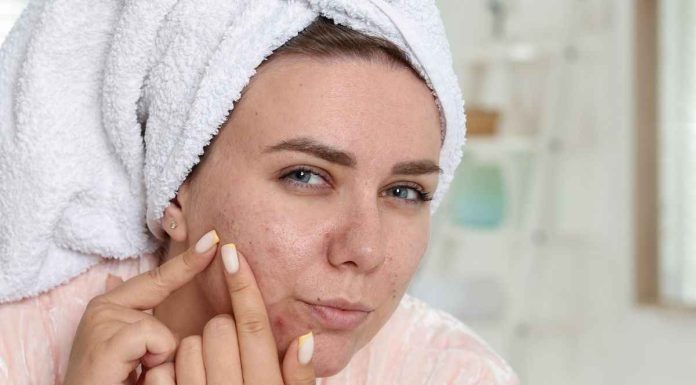 Lotta ai brufoli, in casa hai l’ingrediente per farli sparire subito: è facilissimo rimedi naturali per brufoli