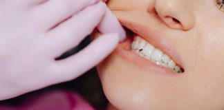 come eliminare le macchie sui denti